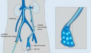 Варикоз Яичников У Мужчин