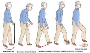 Вестибуло-цефалгический атактический синдром у детей и взрослых ...