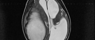 Brain abscess is of inflammatory or post-traumatic origin