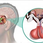Аденома гипофиза: симптомы и лечение