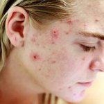 Акне на лице у девушки
