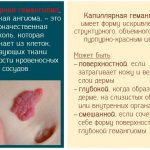 Ангиома кожи. Фото, симптомы и лечение. Народные средства, медикаментозное