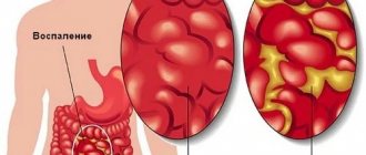 Appendicitis. Symptoms in children 10-11-12-13 years old, from which side, how to determine, signs, clinical recommendations