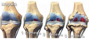 Артроз коленного сустава симптомы и лечение