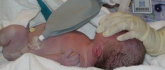 Асфиксия новорожденных проявляется нарушением дыхательной функции