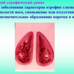 Атрофический ринит