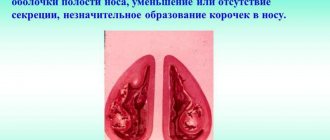 Атрофический ринит