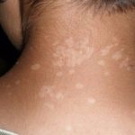 Vitamin deficiency as it manifests itself in adults, photo