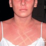 Белый дермографизм