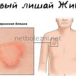 Бляшка при заболевании