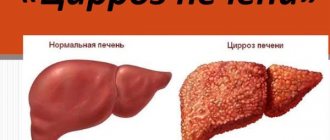 Pain in the right hypochondrium in front. Causes, possible diseases. Treatment, diagnosis