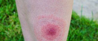 Lyme disease: symptoms and treatment, photo