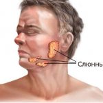 Salivary gland disease