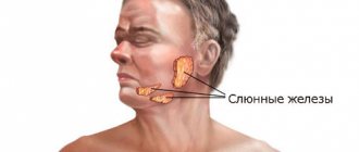Болезнь слюнной железы