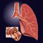 Бронхит болезнь