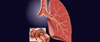 Bronchitis disease