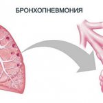 Бронхопневмония (бронхиальная пневмония, очаговая пневмония)