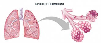 Бронхопневмония (бронхиальная пневмония, очаговая пневмония)