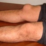 Бурсит коленного сустава фото