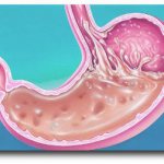 How to treat gastritis of the stomach with high acidity