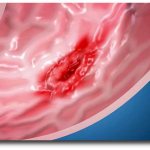 What is gastric erosion and how to treat it