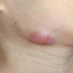 What is lymphadenitis?