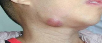 Что такое лимфаденит?