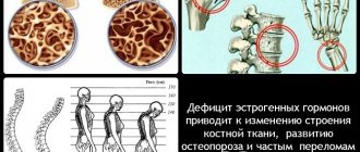 Дефицит эстрогенов приводит к серьезным нарушениям в организме