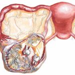 dermoid formation in the ovary