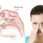 Benign polyp in the nose