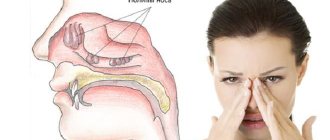 Benign polyp in the nose