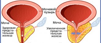 Дуодарт (Duodart) 90 таблеток. Цена, инструкция, противопоказания, побочные действия, аналоги