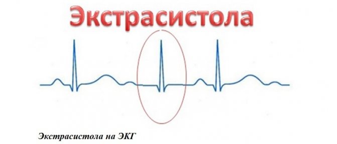 Желудочковая экстрасистолия: причины, симптомы и лечение в статье ...