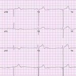 Электрокардиограмма пациента с полной блокадой сердца