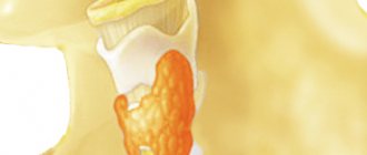 endemic goiter