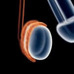 эпидидимит