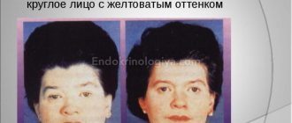 Euthyroidism - what is a disease or condition? Why is euthyroidism dangerous?