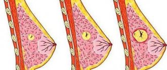 Fibroadenoma of the breast