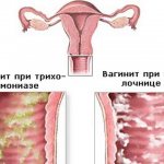 Флагил суппозитории - официальная инструкция по применению