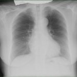 Флюорография фото здоровых легких и больных