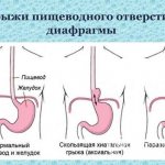 Формы грыжи пищевода