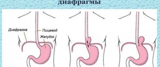 Forms of hiatal hernia