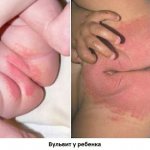 Photo of vulvitis in a child