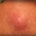 Furuncle under the skin