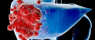 Liver hemangioma