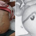 Hepatomegaly in a child