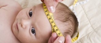 Hydrocephalus of the brain in children under one year of age