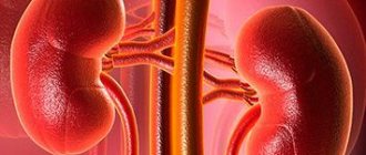 Hydronephrosis