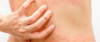 Гормональные мази от аллергии на коже у взрослых и детей. Список эффективных, как действуют