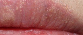 Гранулы Фордайса на губах. Фото, причины, симптомы, лечение, как избавиться
